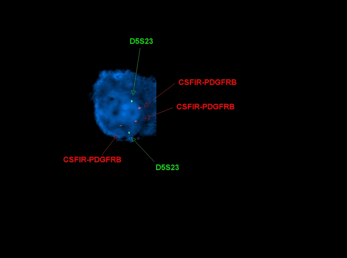 Fluorescent in situ hybridization of LN1 demonstrating PDGFRB translocation.